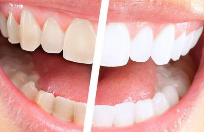 Dental veneers for a smile makeover? Find out more!